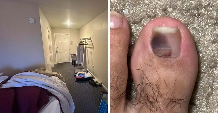 Creepy photos of a hotel room hallway beside a close up view of a bruised toe
