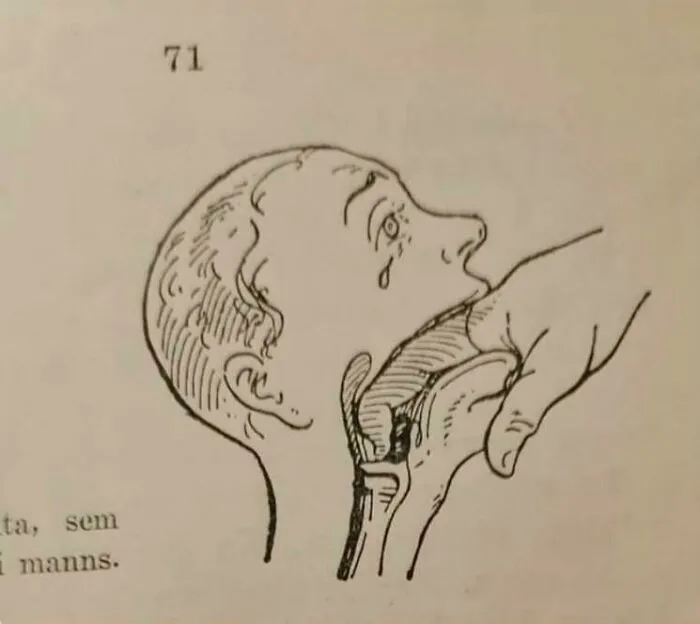 Historical medical illustration showing a rare technique in swallowing or throat anatomy