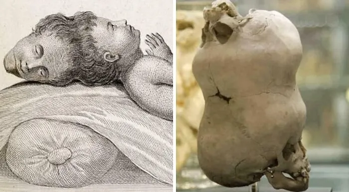 In 1783, A Boy Was Born With Two Heads. The Second Head Was Upside Down, With The Neck Pointed Straight Up