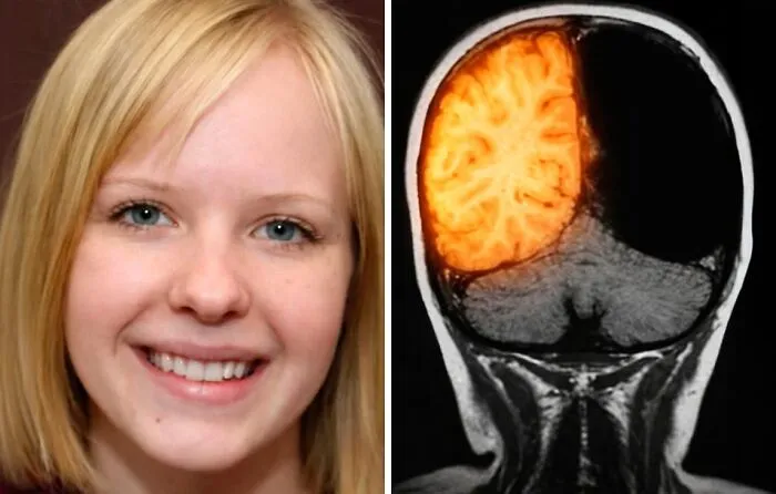 At 8, Christina Santhouse Had The Right Half Of Her Brain Removed After Suffering Up To 150 Seizures A Day