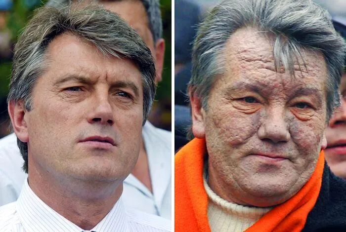 In 2004, Ukrainian Presidential Candidate Viktor Yushchenko Was Poisoned With Dioxin, Leaving His Face Disfigured