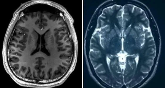 Brain Scans Have Revealed Children Living With Unstable Families (Excessive, Arguing, A***ive And Neglectful) Have Brain Changes Similar To Combat Soldiers After Active Duty