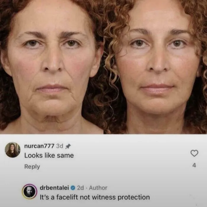 It’s A Facelift, Not Witness Protection