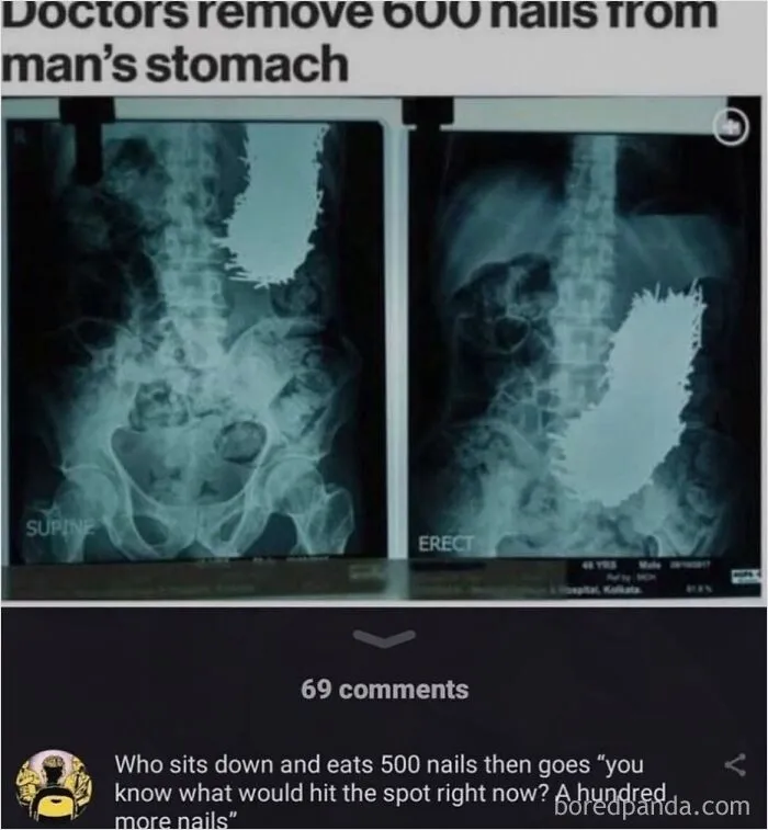 Hilarious internet memes featuring an X-ray of 600 nails inside a stomach with funny comments