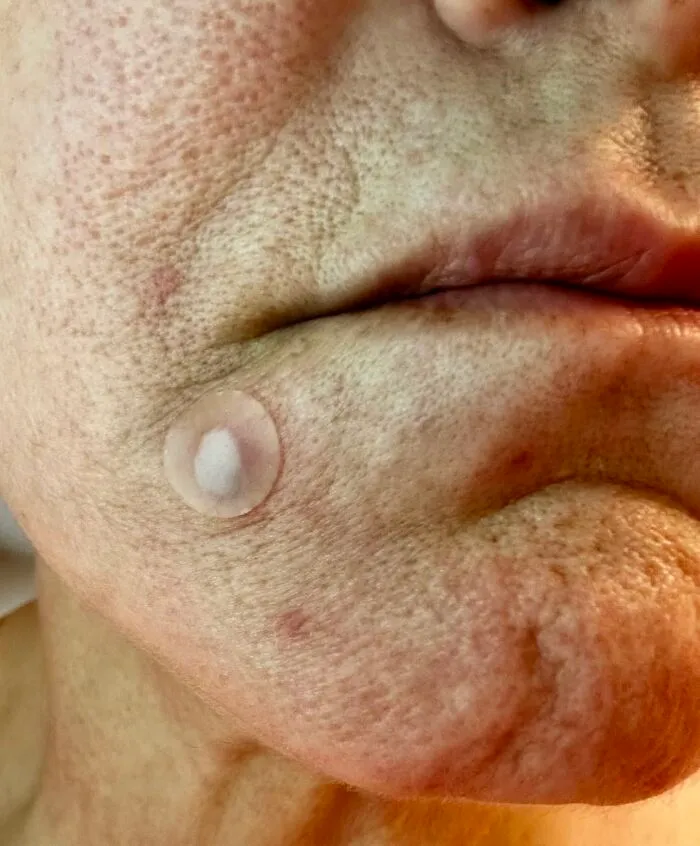 A small round acne patch on a person's chin, showcasing trending items on Amazon.