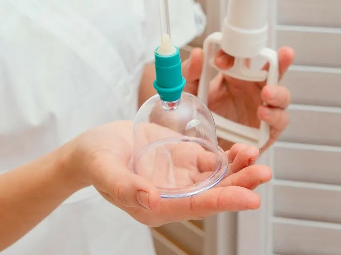 Healthcare workers preparing a glass vacuum cup and pump for cupping therapy