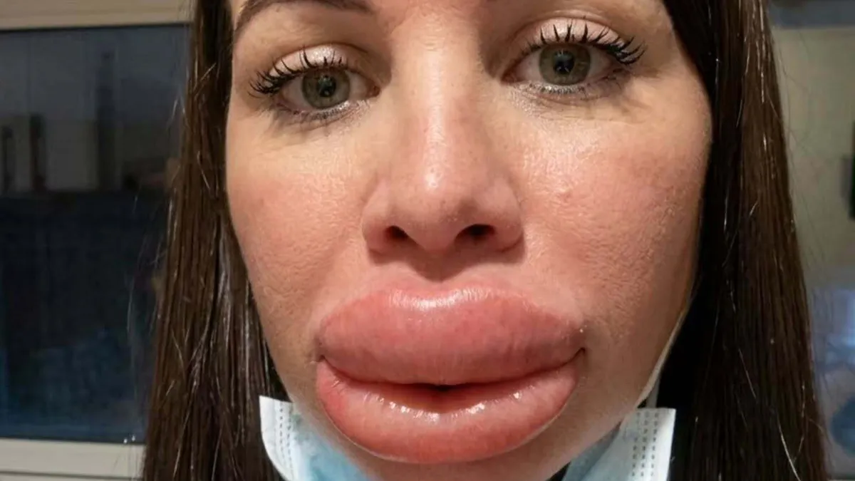 Woman’s Cosmetic Procedure Turns Into A Nightmare, She Ends Up In Tears After Botched Lip Fillers