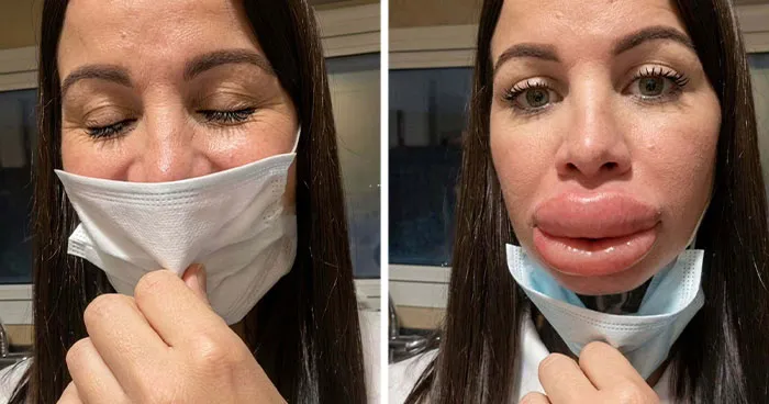 Woman’s Cosmetic Procedure Turns Into A Nightmare, She Ends Up In Tears After Botched Lip Fillers