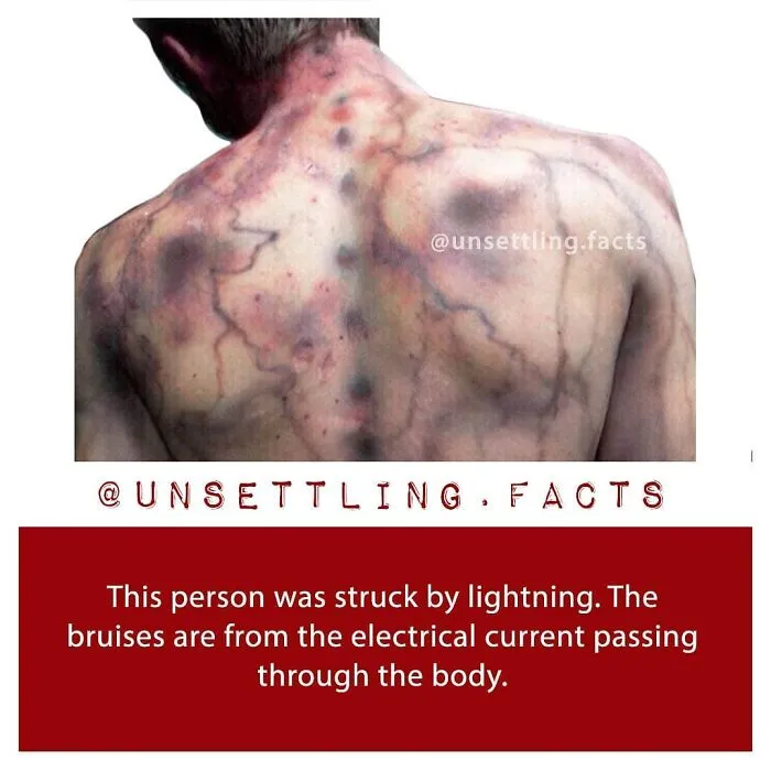 Severe electrical burn marks on a person's back, depicting creepy and unsettling facts about lightning strikes.