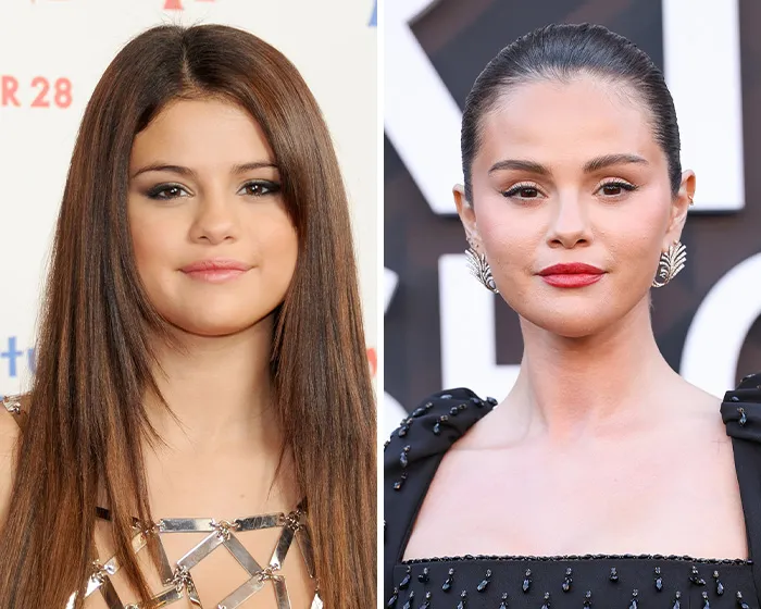 Before and after photo of Selena Gomez highlighting potential blepharoplasty plastic surgery.