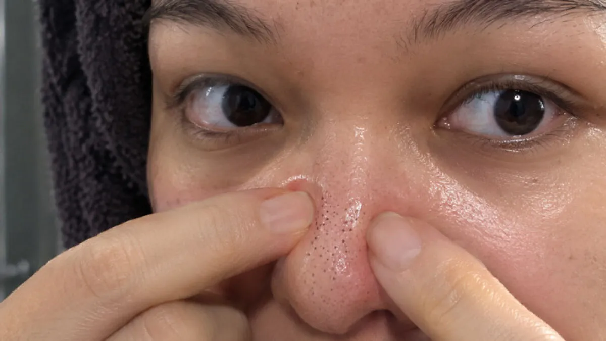 Dermatologist Warns Squeezing Black Spots On Your Nose Is A Serious Mistake Because They're Not What You Think