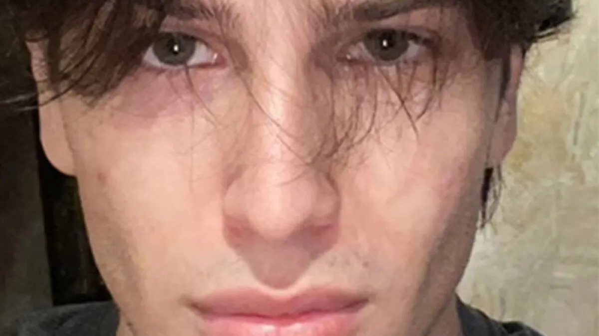 From Botox To $35,000 Jaw Surgery: The Extreme Procedures Promoted At A Looksmaxxing Camp