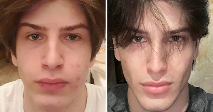 From Botox To $35,000 Jaw Surgery: The Extreme Procedures Promoted At A Looksmaxxing Camp