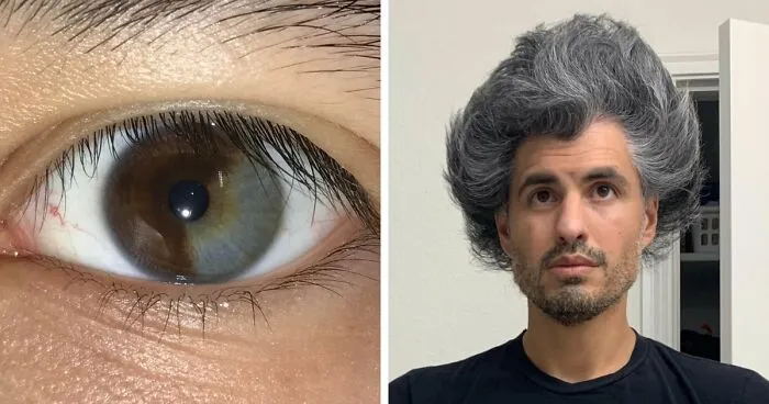 66 Cool Pics Of Unusual Body Traits And Conditions People Have
