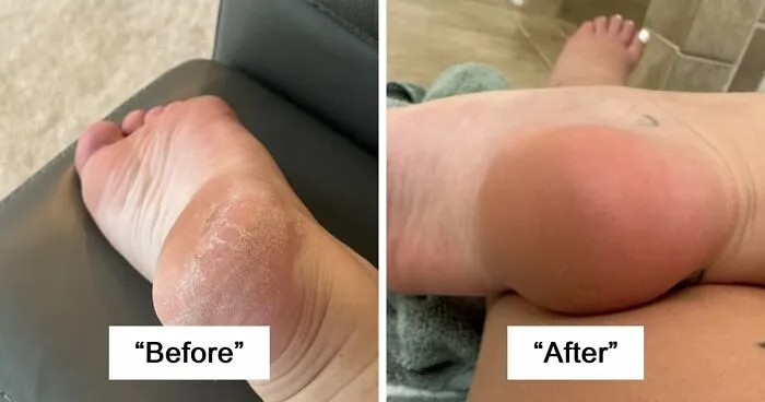 Before and after of dry heel treatment, an Amazon trending item