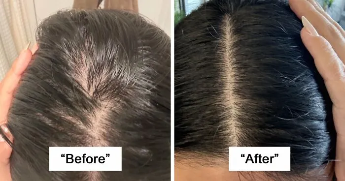 Before and after of hair growth treatment during Big Deal Days