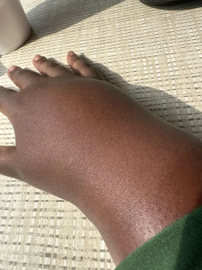 A severely swollen hand resting on a table, shown in creepy photos of unusual injuries