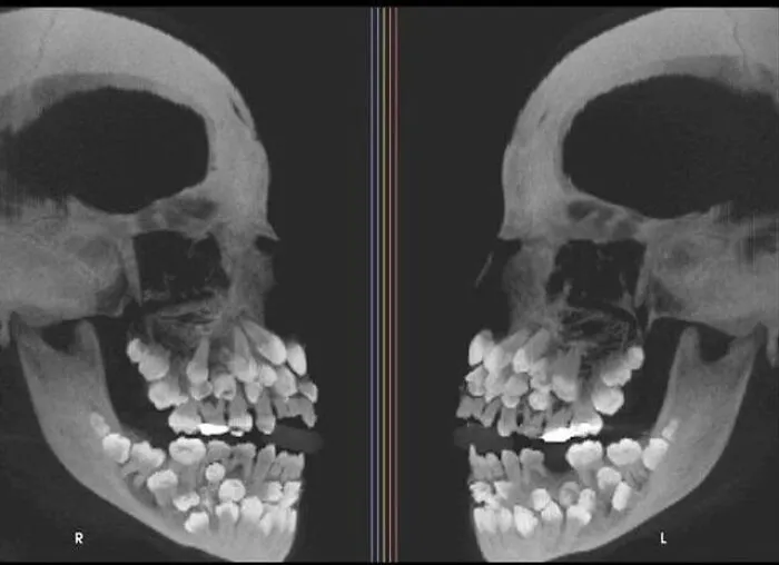 A weird and creepy X-ray photo showing a human skull packed with an excessive amount of teeth.