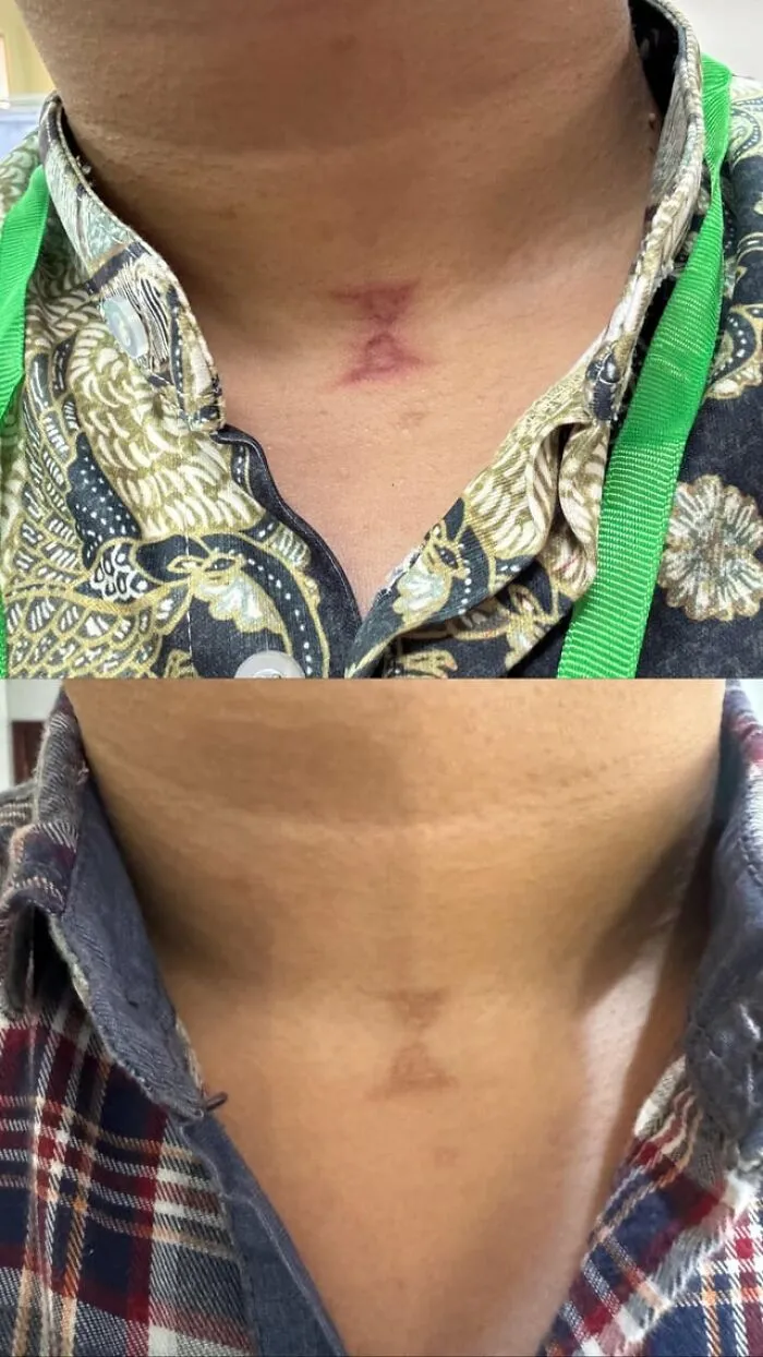 Slightly creepy photos showing an hourglass shaped scar or mark on a person neck.