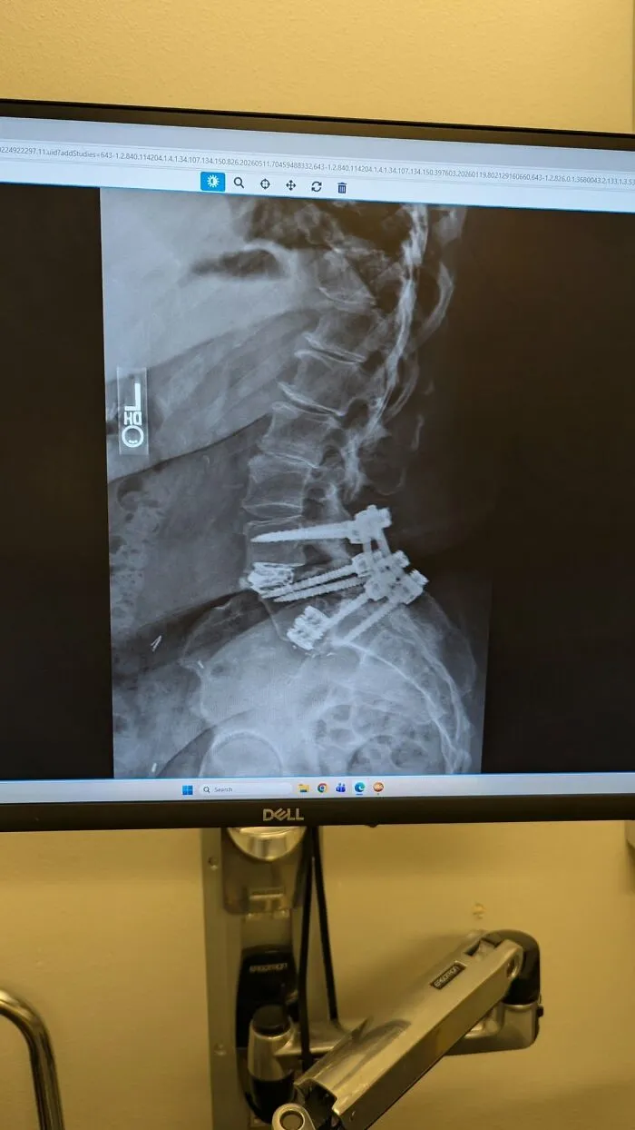 Spinal x-ray scan displaying surgical screws and hardware from disturbing medical photos