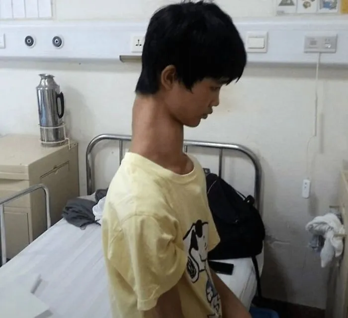 A young man in a hospital room showing an unusually long neck, featured in disturbing medical photos.
