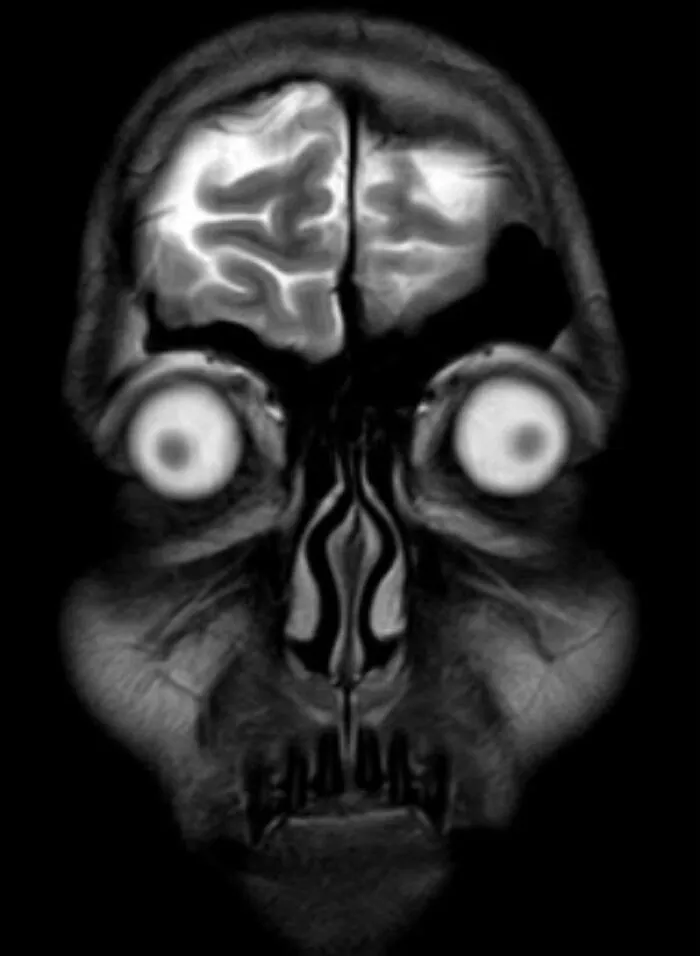 A front-facing coronal MRI scan of a human head with large visible eyes, part of disturbing medical photos.