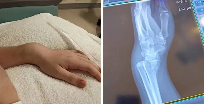 Medical photo of a deformed wrist alongside an X-ray showing fractured bones.
