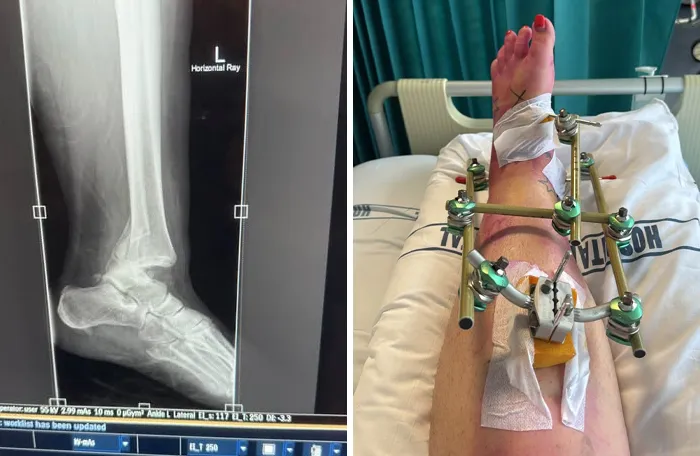 Ankle X-ray alongside a leg fitted with an external fixation frame in medical photos.