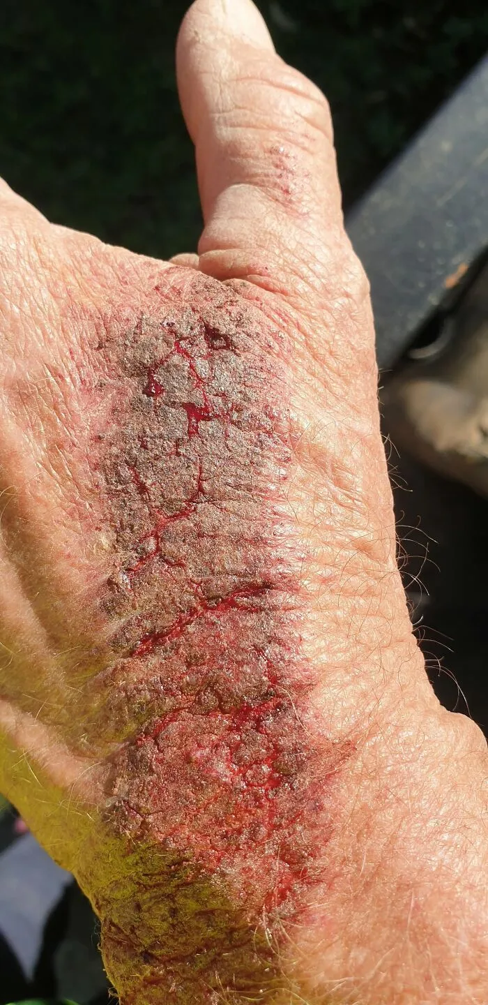 Close-up of severely dry cracked skin on a hand featured in medical photos.