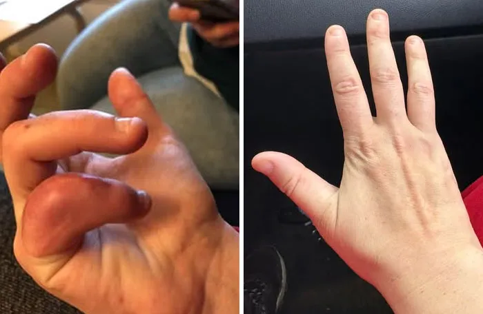 Side-by-side comparison of swollen hand and recovered hand showing medical photos.