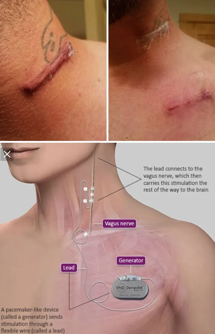 Surgical incisions and diagram of vagus nerve stimulation device in medical photos.