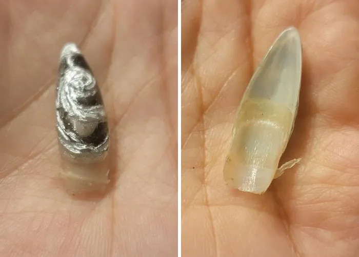 Person holding a detached fingernail in palm, part of disturbing medical photos