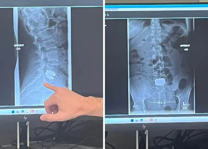 Doctor pointing at lumbar spine x-ray on screen from interesting medical photos