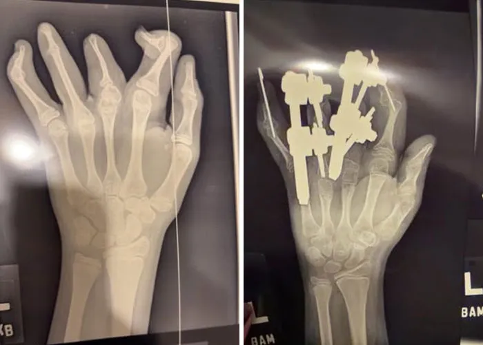 X-ray comparison showing hand bones before and after surgical fixators from medical photos