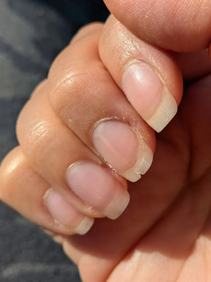 Medical photos showing a close-up of fingernails with a small split on the index finger