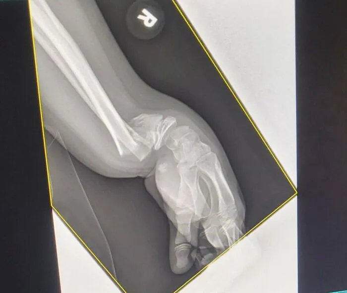Medical photos showing a severe wrist and forearm bone fracture on an X-ray scan