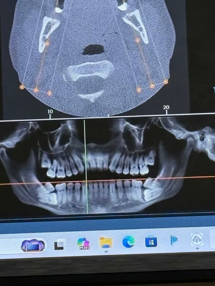 Medical photo of a dental scan showing extra teeth embedded within the upper jaw bone
