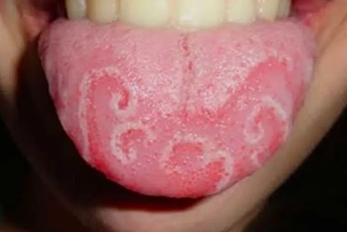 Interesting medical photo showing a close-up of a human tongue affected by geographic tongue condition