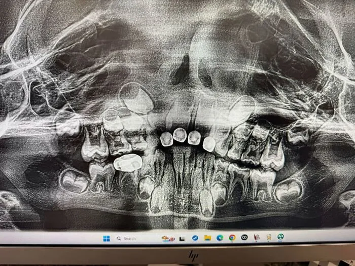 Disturbing medical photo of a dental X-ray displaying severe hyperdontia with dozens of extra teeth