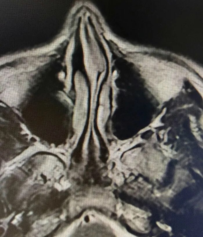 Interesting medical photos displaying a CT scan view of a severely deviated nasal septum.