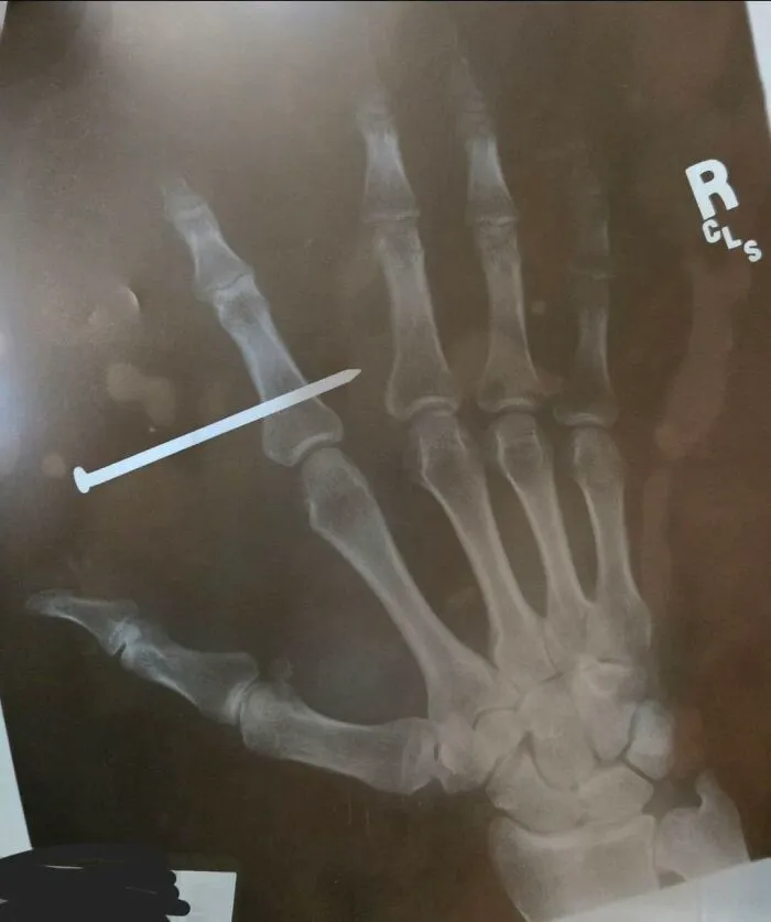 Disturbing medical photo X-ray of a hand pierced through by a metallic nail.