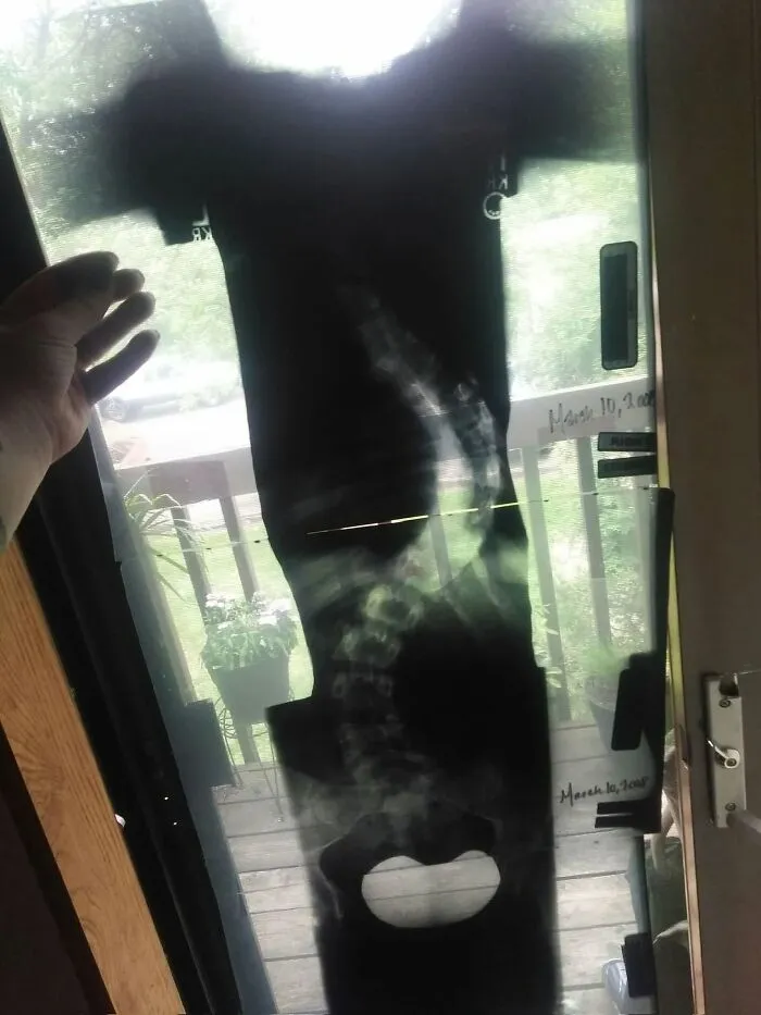 Medical photo spine X-ray held up to a window showing severe spinal curvature.