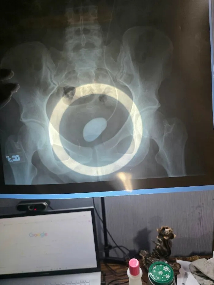 Disturbing medical photo X-ray of a pelvis revealing a large foreign object.