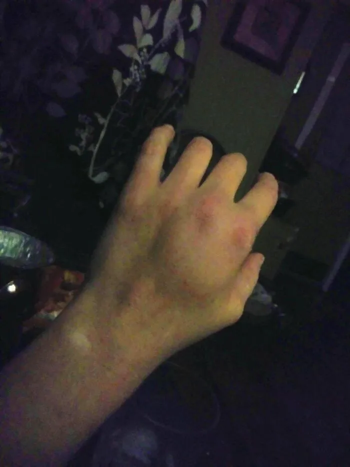 A hand showing a severe injury or deformity, featured in disturbing medical photos.