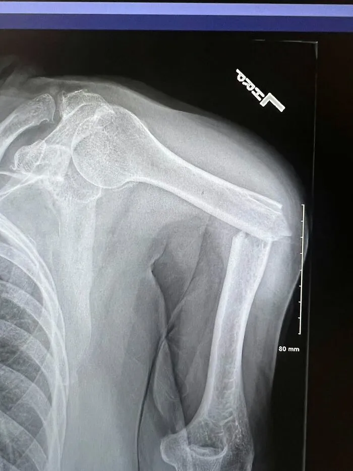 Medical photo shoulder X-ray displaying a clean fracture in the upper arm bone.