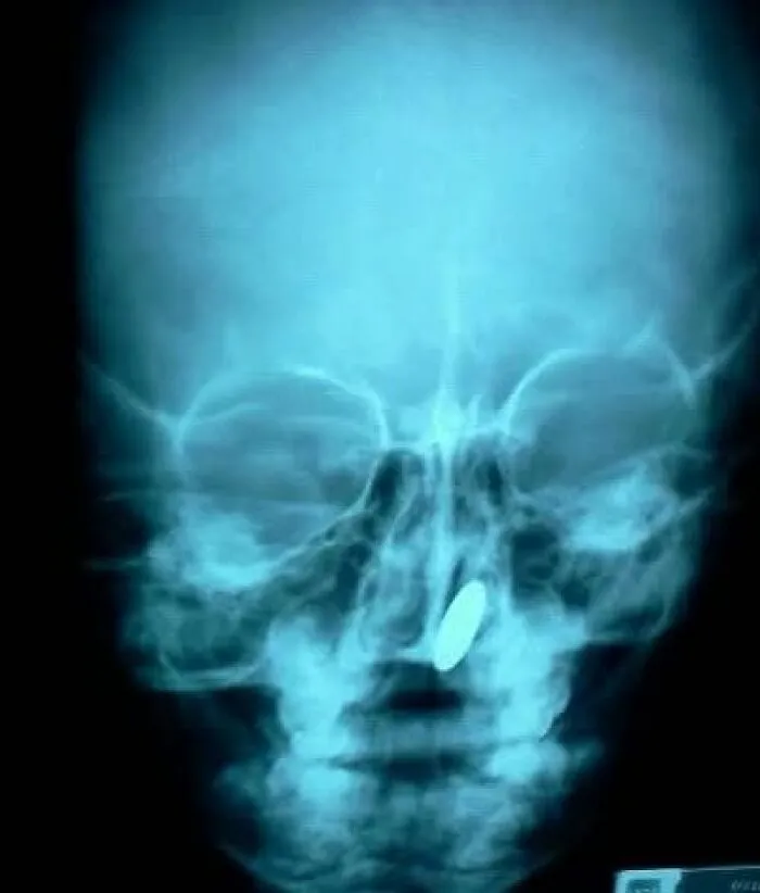 Medical photo skull X-ray showing a foreign object lodging in the nasal cavity area.