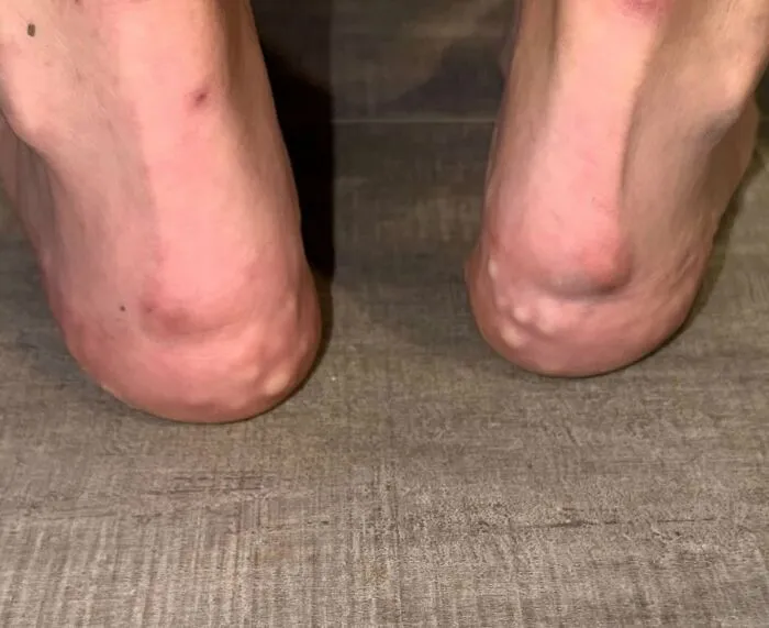 Medical photos of piezogenic papules visible as small bumps on the heels of feet