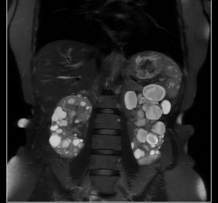 Disturbing medical photos showing an MRI scan of polycystic kidneys filled with fluid sacs.