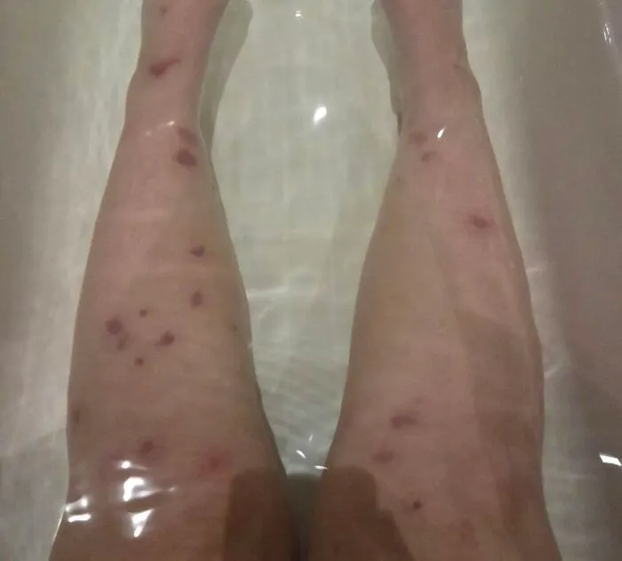 Interesting medical photo showing legs submerged in water with red skin spots.