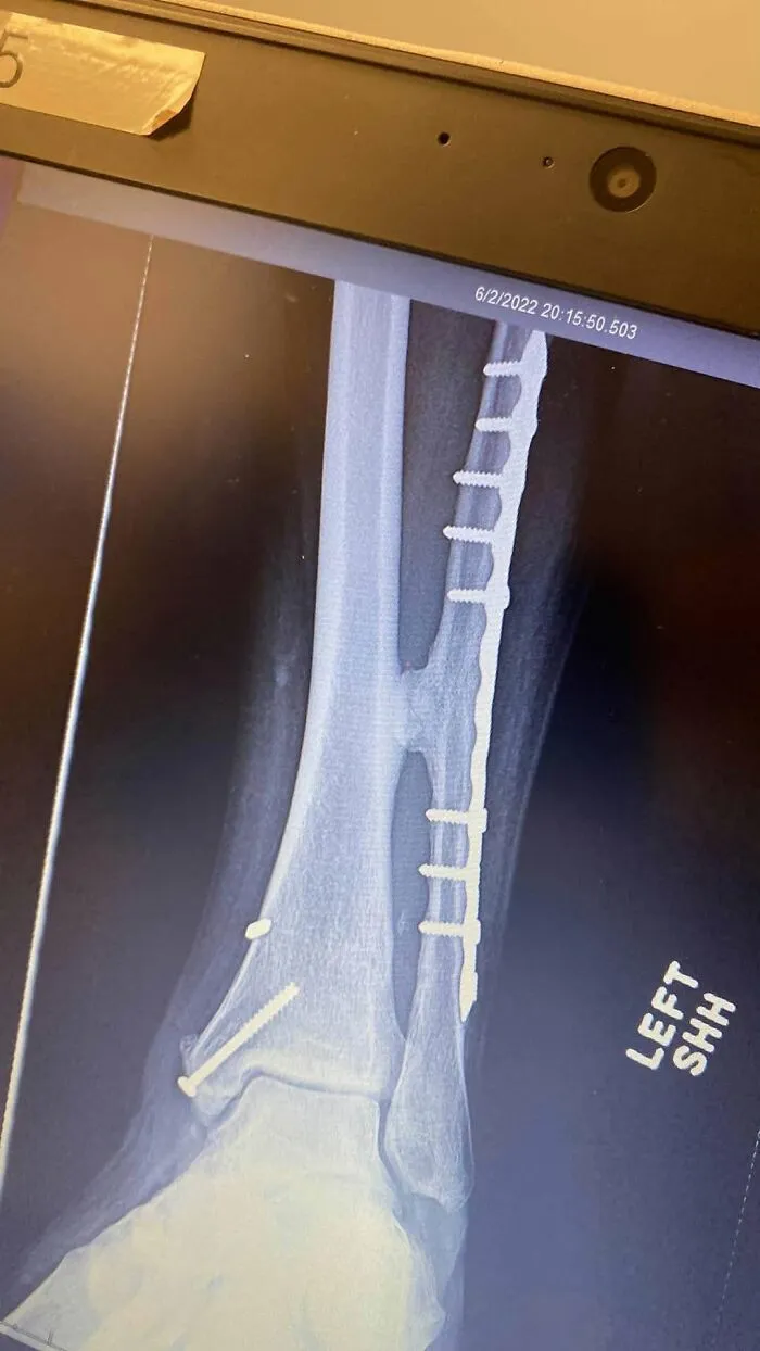 Disturbing medical photo of a leg X-ray with surgical plates and screws.